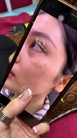 Cập nhật da nám đinh #chamsocdaseo#chamsocda#chamsocdamun#chamsocdanam#tanbinh#govap #Lequynh#Lqspa#hocnghespa  #chamsocda #lequynhspa #vienthammylqspa #nanmunbangtay #nanmunbangtambong#nanmunbangcay