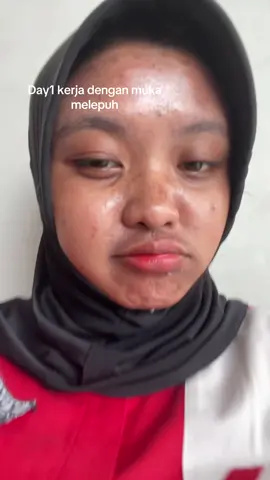 Redup untuk bersinar kawann #fyp #pertamina #peelingskin 