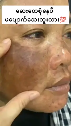#တင်းတိတ်ပျောက်ချင်သူများအတွက် #ထောပတ်သီးတင်တိပ်ပျောက်ဆေး #ပင်းရင်းတိုက်ရိုက်မို့ယုံယုံကြည်ကြည်မှာလို့ရနေပီနော် #5500တန်လေး #thankuniverse🌍 #Thura✅ 