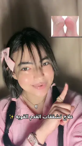 علاج تشققات القدم القويه 😴🎀..