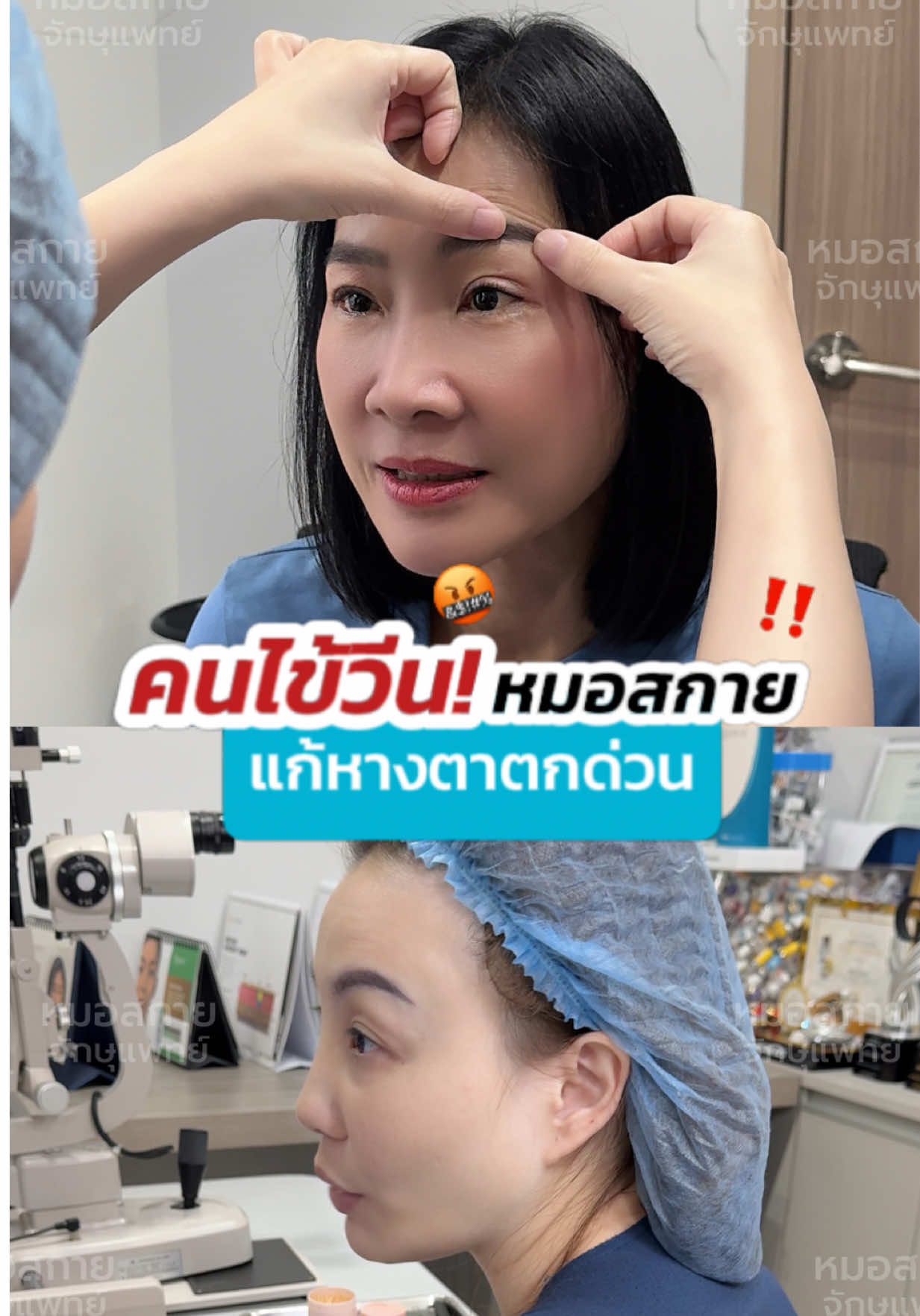 คนไข้วีน‼️ ให้ช่วยแก้ #หนังตาตก #หางตาตก  ##หมอสกาย#จักษุแพทย์#หมอตา #skyclinic #ศัลยกรรมตา #รีวิวตาสองชั้น #สกายคลินิก #ทำตาที่ไหนดี