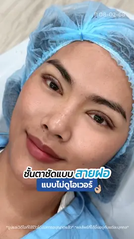 ชั้นตาชัด แต่ไม่หอยแครง เป็นยังไงมาดู ‼️ #หมอสกาย #skyclinic #รีวิวตาสองชั้น #ทำตาที่ไหนดี #จักษุแพทย์ #สกายคลินิก #ศัลยกรรมตา 