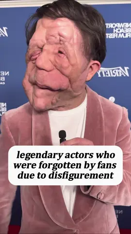 Legendary Actors WhoWere Forgotten By FansDue To Disfigurement