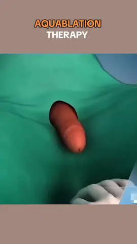 Aquablation Therapy For Enalrged Prostate Treatment! (3D Animation) #enlargedprostate #bph #benignprostatichyperplasia #benignprostatichyperplasiatrea 