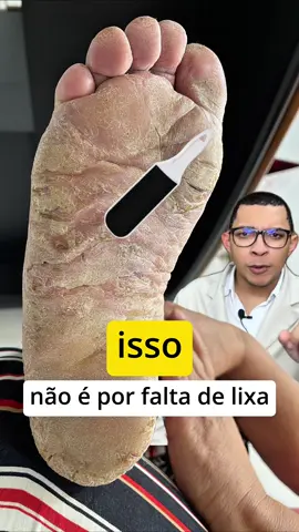 🔴 Pés rachados e doloridos? Pode ser psoríase plantar! ⠀ Nem toda rachadura no pé é só “ressecamento”. A psoríase plantar é uma forma de psoríase que afeta a sola dos pés, causando placas espessas, vermelhas, com descamação e fissuras dolorosas. ⠀ Muita gente confunde com micose ou dermatite, mas o tratamento é diferente! ⠀ 🧴 Pode ser necessário usar cremes com corticoides, derivados de vitamina D, fototerapia e, em alguns casos, medicamentos sistêmicos. ⠀ Se seus pés estão assim há muito tempo, procure um dermatologista! Diagnóstico correto é o primeiro passo para melhorar sua qualidade de vida. ⠀ 👣 Curtiu a dica? Salve para lembrar e compartilhe com quem precisa ver isso! #psoriase 