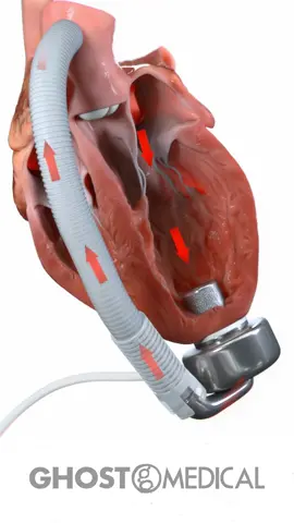 Ghost Medical created a high-fidelity 3D animation for CorWave’s left-ventricular assist device (LVAD), a pump driven by an electromagnetic, undulating membrane that recreates a physiological pulse.  By showing how this pulsatile design differs from conventional continuous-flow LVADs, the piece underscores potential hemocompatibility benefits: six-month pre-clinical implants ran without thrombosis or device failure, hinting at a lower clot risk, while clinical evidence is still being gathered. When @9News Australia reported the first-in-human implant at St Vincent’s Hospital (@St Vincent’s), Sydney, on 9 July 2025, the broadcast used segments of our animation to help viewers understand the device’s action.  The project shows how rigorous, science-based storytelling can translate breakthrough cardiac technology for specialists and the public alike. #lvad #heartfailure #cardiology #awareness #medicaldevice 