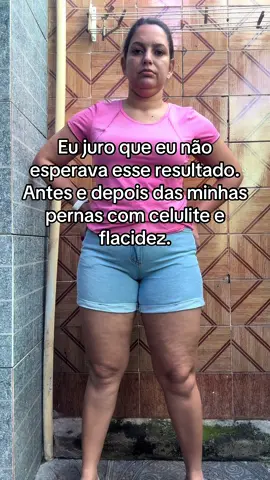 Eu achava que nunca ia melhorar. #lipedema#celulite#flacidez#mulheres#fypシ゚ 