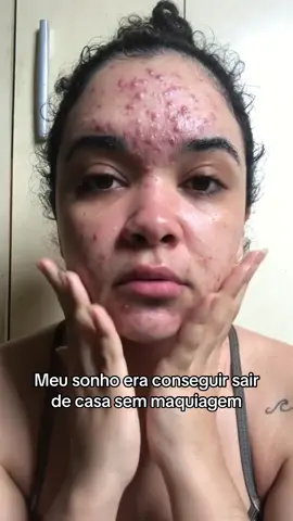 O produto que curou a minha acne e transformou a minha vida! Vende no @Mercado Livre ID: 2OLK9M-Q5VH só colocar na barra de pesquisa no site ou no app #MeusFavsDoMercadoLivre #MercadoLivre 