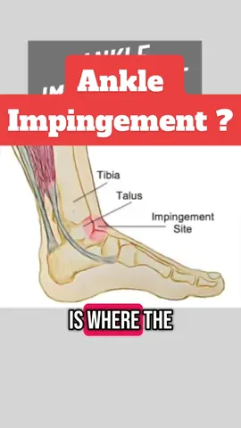 Fix Your Ankle Impingement — FAST! 🚨 Struggling with sharp ankle pain during squats, lunges, or running? It could be ankle impingement — and the good news is: you can do something about it 💥 In this video, I’ll show you the top exercises to reduce pain, restore ankle mobility, and get you back to full function without the pinching 👣 ✅ Mobility ✅ Stability ✅ Long-term relief Whether you’re an athlete or just want to move pain-free — these drills are game changers. remember to check out the video on the tube.  📌 Save this for later & share it with someone who needs it! #ankleimpingement #anklepainrelief #anklemobility #anklerehab #mobilitydrills #sportsrehab #injuryprevention #physicaltherapytips #fixyourankle #anklestability #squatmobility #rehabexercises #dorsiflexion #movementtherapy #physioreel #fitnesstips #prehabworks #mobilitymatters #runnersproblems #jumptraining #gympainfix #ankleinjuryrecovery 