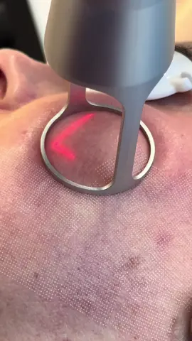 Mais um rostinho rejuvenescido pelo CO2 e suas associações. #co2 #linhasdeexpressão #rejuvenescimento #porosdilatados #laserdeco2 