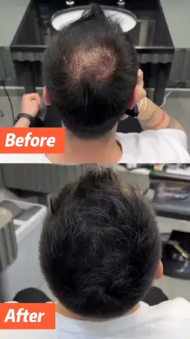 🔥 Fill bald spots, patchy beards & sparse brows – in seconds! BUNEE Hair Concealer Cream is the all-in-one solution for flawless hair, beard & brows. Whether it’s thinning hair, a patchy beard, or uneven eyebrows – we’ve got you covered! ✨ Why You’ll Love It: ✅ Instantly covers bald spots & hair gaps ✅ Works on hair, beard, and eyebrows ✅ Waterproof, sweatproof, and smudge-resistant ✅ Natural matte finish – no shine, no flaking ✅ For men & women 🎁 Buy 2, Get 1 FREE + FREE Express Shipping! 🛒 Shop now: [https://hairbunee.com/products/hair-concealer-cream] #BUNEE #Hairbunee #touchup #beauty #makeup #hair #roottouchup #grayhaircover #brows #creambrows #concealer #makeup #foundation #beauty #concealertutorial #darkcircles #makeuptutorial #instamakeup #flawlessbase #concealerbrush #fullcoverageconcealer #concealerpalette #beforeandafter #fyp #reels #reels__tiktok