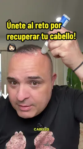 Body wise hair growth serum roll-on es el producto que estoy utilizando en la lucha por recuperar mi cabello perdido #bodywisehairgrowthserum #balding #hairlosssolutions #bodywise #hairgrowth #hairlossremedy #resultsmayvary 