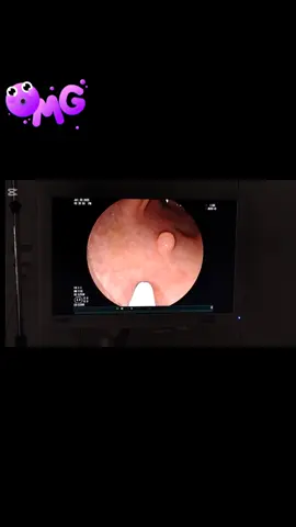 Un día normal de trabajo #gastroenterologia #endoscopy #enfermedades #traba #medicina 