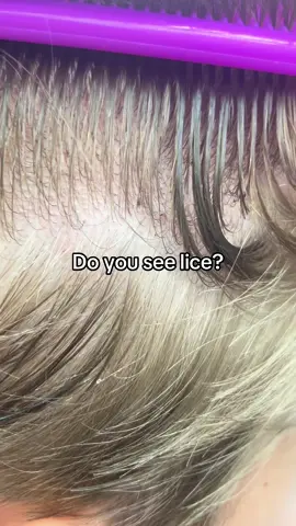 Do you see lice? l lice removal #fyp #hair #momlife #school #lice 