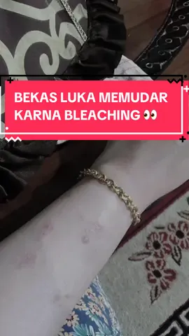 Yang banyak punya bekas luka, bekas gatal, wajib di bleaching biar ilaaaang !  #bleachingbadan #pemutihbadan 