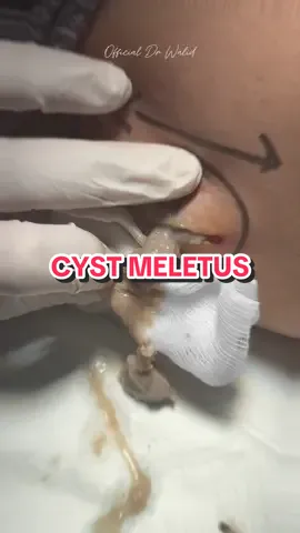 PUAS KAN TENGOK NANAH KELUAR PERCIK SATISFYING 😮‍💨💥 Cyst ni nampak kecil je kan tapi bila picit boleh nampak isi dia keluar meletus bukan main banyak isi dalam dia! Korang ramai yang suka tengok video macam ni sebab rasa lega + satisfying kan 👀 Kita bawa semula video ni untuk bagi awareness dan bagi korang tengok sekali lagi betapa pentingnya rawatan awal 🤕🤭 Jom Jom buang dengan Dr Walid, lagi bersih, lagi selamat! 💉 📍 Poliklinik Walid Ampang KL 📍 Poliklinik Walid Tasek Gelugor Penang #CystPopping #KeluarNanah #DrWalid #Satisfying #cyst #cystpop #pimple #abscess #bisul #MinorSurgery #FYP #MedicalTikTok #satisfyingvideos #fypシ゚viral #fyppppppppppppppppppppppp #poliklinikwalid 