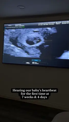 The way my husband was speechless 😭 Rate was 135! Measuring in at 7 weeks, 1 day and I am 7 weeks 4 days. Keep growing you little blueberry 💖 this was on the trans abdominal ultrasound and the quality wasn’t the best but I go in on Monday at the clinic and we should have clearer results and baby may look more like a baby haha. So happy to hear everything is going well and to finally hear his heartbeat. Keep growing. Can’t wait to meet you. #miracle #baby #babyheartbeat #abdominalultrasound #7weeks4days  #ivf #ttc #ivfround2 #ivfround3  #ivfjourney #ivfstims #ttcjourney #eggretrieval #ttccommunity #eggretrievalprocess #ivfmeds #ivftransfer #ivfstory #gonalf #ivfstims #stims #infertilitystruggles #infertilityjourney #infertility #pcos #endo #endometriosis