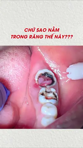 Tuỷ mọc lợi trong răng?? Đây là tình trạng gì 😲😲 #viemtuy #nhakhoa #suckhoerangmieng☘️ #kienthucnhakhoa #iìnormation #saurang 