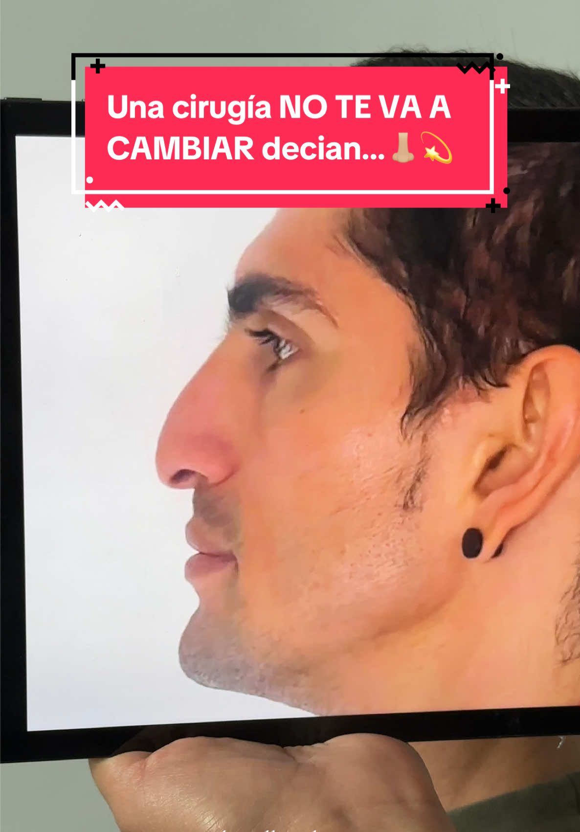 Todo cambio en la vida representa la toma de decisiones, así que atrévete a lucir tu mejor versión. El día de hoy una Rinoplastia masculina ultrasónica. #rhinoplasty #facialplasticsurgery #drwilliambecerra #rinoplastia #antesydespues 