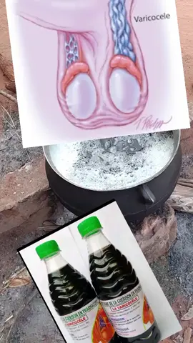 traitement naturel contre la varicocèle testiculaire 
