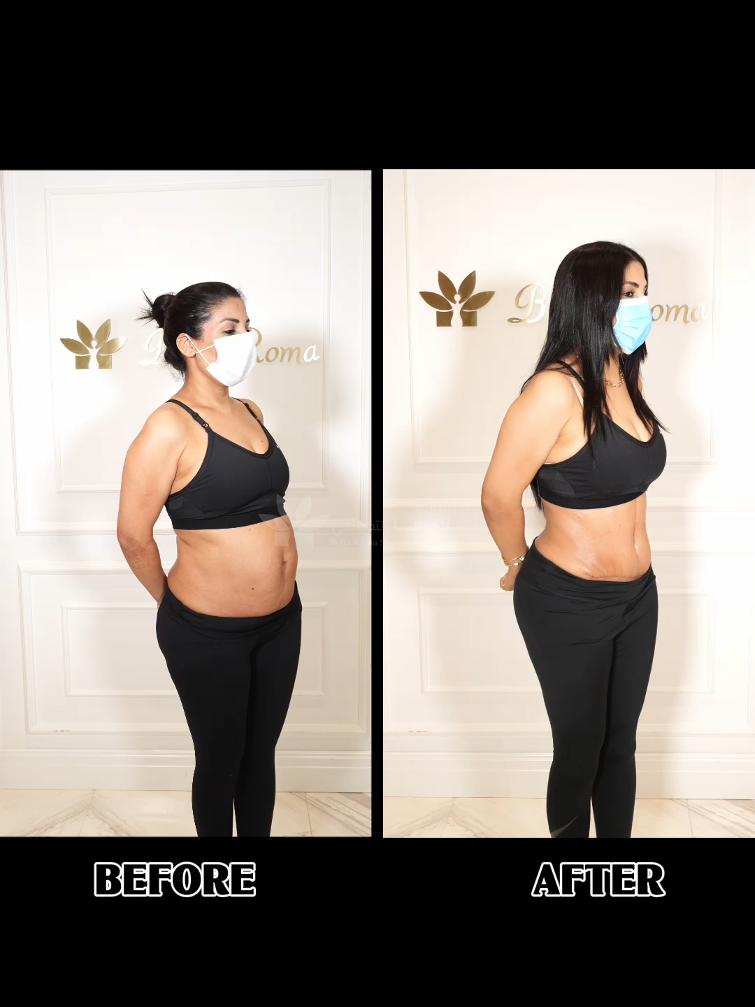 See the transformative results of a skilled surgery that restores confidence and contour. ABDOMENPLASTY Surgery #liposuctionnonsurgery #foryou #foryoupage #beauty #cosmetics #lipedema #lipo360 #SnatchedWaist #bellaromahospital #snatchedwaist #liposuction #tummytuck