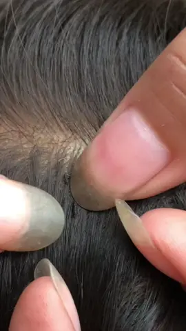 #omg #lice #liceremoval 