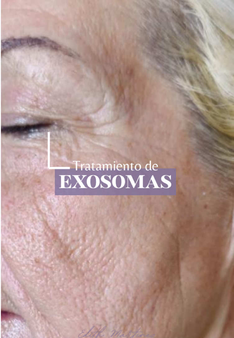 ✨¿Escuchaste hablar de los exosomas?  👉🏻La revolución en tratamientos faciales ya está acá. 🌟Reparan, regeneran y rejuvenecen desde adentro, potenciando los resultados como nunca antes. -En este reel te cuento qué son, cómo actúan y todos sus beneficios 💉 ✨ #exosomas #estetica #centrodeestetica #tratamientofacial #rejuvenecimientofacial #esteticatemperley #esteticapalermo #esteticafacial 