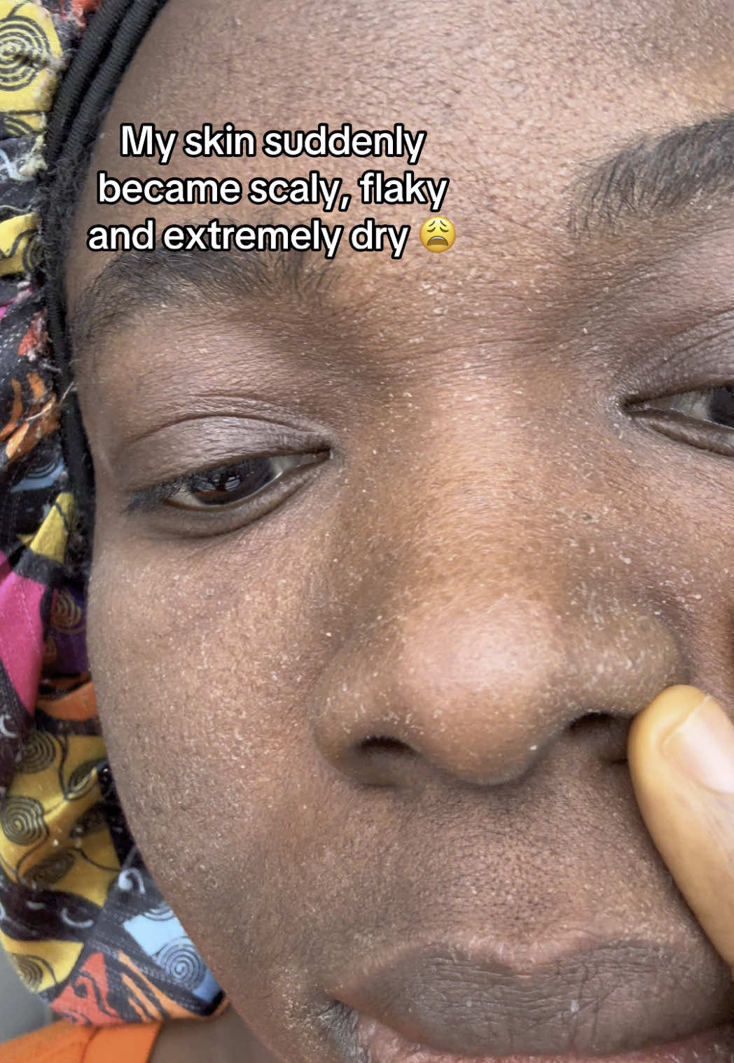 I cut out tap water and washed my face with bottled water till I stopped flaking, then I replaced my shower head with a filtered one.  