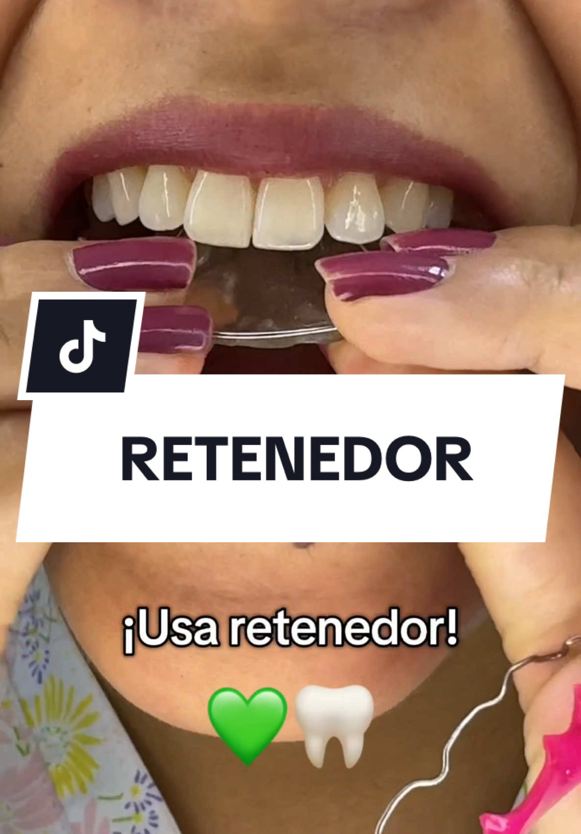 📍UBÍCANOS en:                                                                                               Av. Tomás Valle Cuadra 1 San Martin de Porres. 𝐅𝐫𝐞𝐧𝐭𝐞 𝐚 𝐥𝐚 𝐩𝐮𝐞𝐫𝐭𝐚 6 𝐝𝐞𝐥 𝐦𝐞𝐫𝐜𝐚𝐝𝐨 𝐂𝐞𝐧𝐭𝐫𝐚𝐥 𝐅𝐞𝐯𝐚𝐜𝐞𝐥 𝐲 𝐚 𝐮𝐧𝐚 𝐜𝐮𝐚𝐝𝐫𝐚 𝐝𝐞 𝐥𝐚 𝐀𝐯. 𝐓𝐮𝐩𝐚𝐜 𝐀𝐦𝐚𝐫𝐮. LIMA- PERÚ 🇵🇪 . . 📲 936 622 834  . . . #Brackets #retenedor #LimaPerú 🇵🇪 #dentistalimanorte #limanorte   #cambiodesonrisa #diseñodesonrisa  #mentadentistas #atenciondomigos #domingo 
