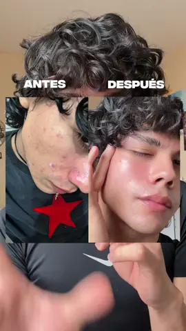 el secreto para despigmentar tu piel DE VERDAD  #kbeauty #niacinamide #acne #skincare #anua @anua_global