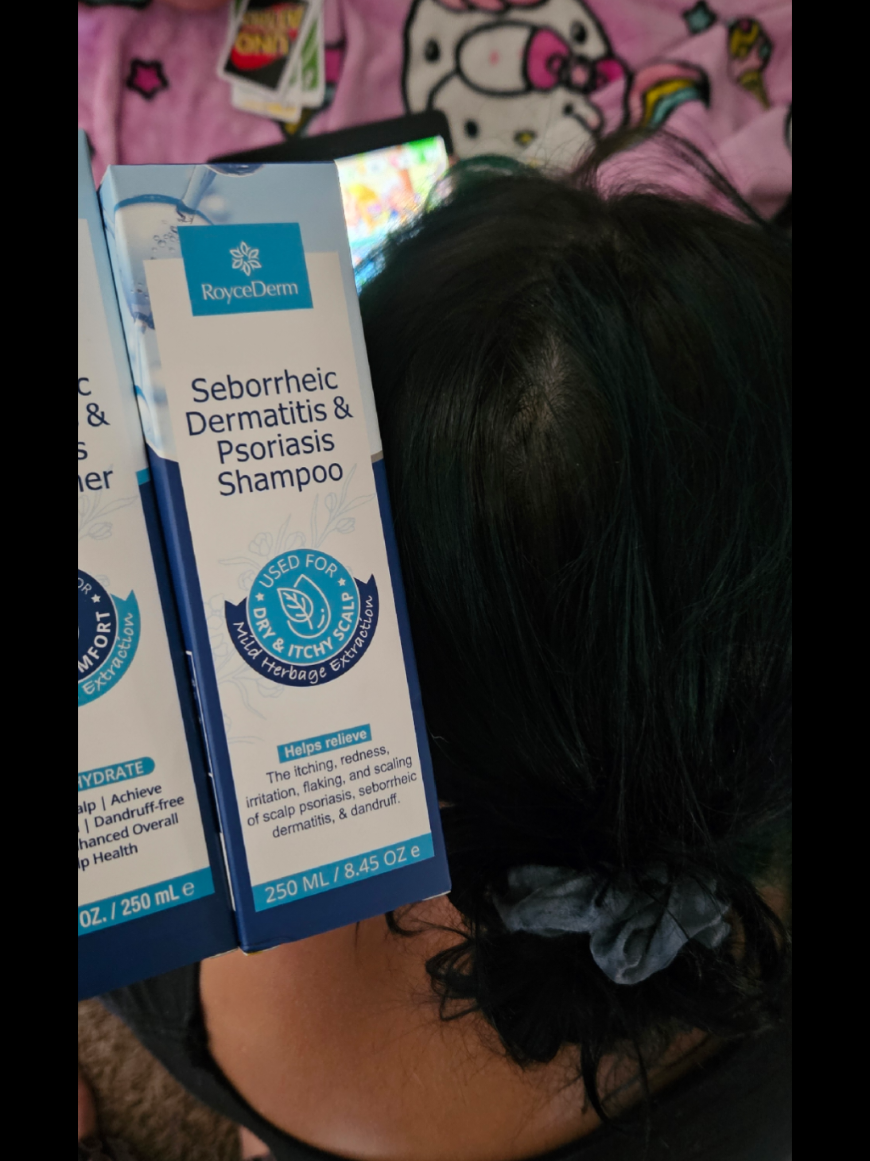 I will definitely keep repurchasing this for her. This is the 1st thing thats helped her this much.  #eczema #sebhorreicdermatitis #dermatitis #scalp #scalpcare 
