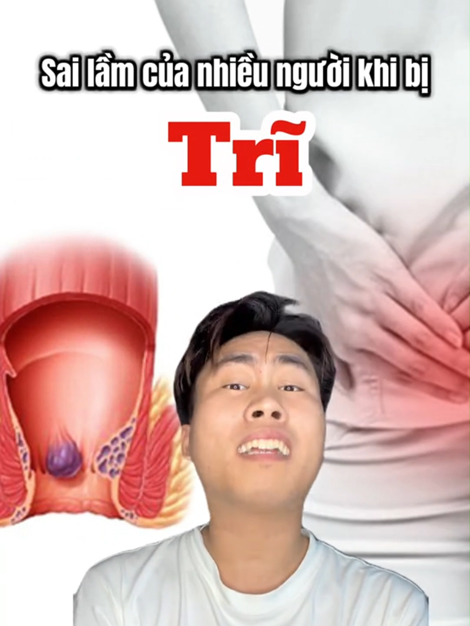 Sai lầm của nhiều người khi bị trĩ #benhtri #trinoitringoai #fyp