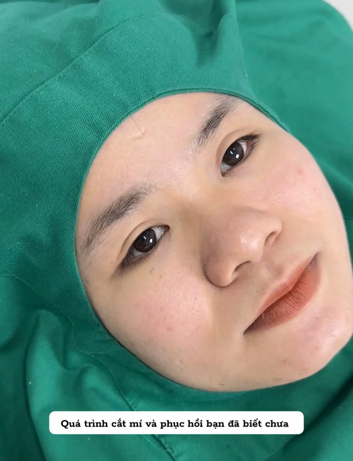 Quá trình cắt mí trong 7 ngày 🥰 #catmi #nhanmi #midep #catmidepuytin #mifull 