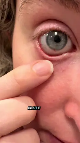 Day in the life baby. 😭 Not cool eyes, not cool. 😤 #scleralenses #dryeyedisease #ocularsurfacedisease #stevensjohnsonsyndromesideaffects #bostonsight #hardcontacts 