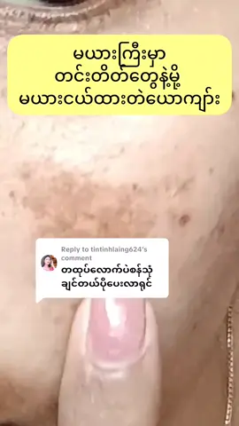 Replying to @tintinhlaing624 #တင်းတိတ်ပျောက်ဆေး #တင်းတိတ်အမဲစက်အတွက် #tinzaraye🌻 #avocadofacemask🥑 #foryou #တထုပ်၅၅၀၀ #fpy 