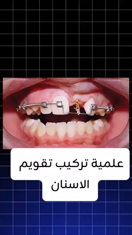 تركيب تقويم الاسنان #زراعة_اسنان #تسوس_أسنان #تقويم_الأسنان #طب_اسنان #اسنان 