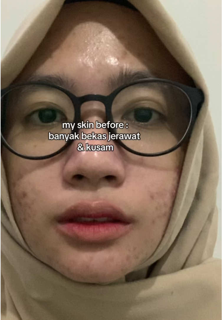 Hempas kusam&bekas jerawat!Aku jatuh cinta sama day creamnya ya, soalnya jadi solusi buat yg lagi mager makeupan, pake day cream aja udah autocakeuppp maximal! 🫶🏻 #mkskinjktbanten #mkskin #mkskinpaketmelacare @MKSKIN TEAM JAKARTA - BANTEN #mukakusam #bekasjerawat #flekhitam #bekasjerawathitam #pih #postinflammatoryhyperpigmentation #mukacerah #mukaglowing #GlowUp #glowuptips #glowupjourney #acnejourney #acnetips #acnescar #acnefighter #acneproneskin #jerawatan #breakoutskin #breakout #jerawat #beautytips #BeautyTok 