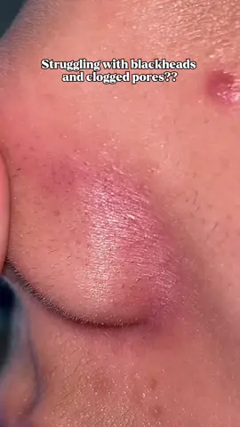 Blackheads and whiteheads no more with this volcano claystick from @Glad2Glow.ph 🩶 #claystick #claymask #g2gvolcanoclaystick #g2gph #fypシ゚viral 