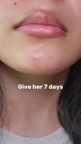 Say goodbye to acne in 7days with Purito Mighty Bamboo Panthenol Cream. #purito #panthenolcream #koreanskincare #glowcream #glowingskin #acneskin #7dayschallenge #skincareroutine #viralmoisturizer #viralcream #skintok 
