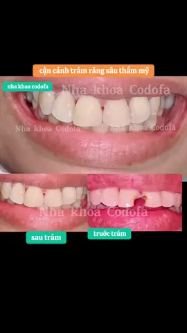 #trám_răng_sâu #trámrăng_sứt_mẻ #trám_răng_thưa #nhakhoacodofa #làm_răng_sứ_trả_góp 