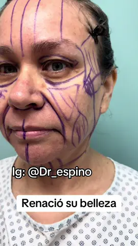 Rejuvenecimiento facial avanzado #rejuvenescimentofacial #DeepPlane #Tijuana #Fyp #LosAngeles #Cdmx #Texas 