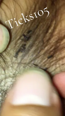 Remove lice #😱😱😱omg #😭😭😭 #liceremoval #🥶🥶🥶 #like 