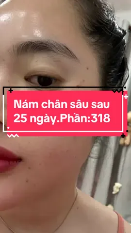Quá trình xử lí nám chân sâu sau 15 ngày !!! #oanh_chuyên_trị_nám #chuyên_giải_quyết_các_vấn_đề_về_da #điều_trị_nám #oanh_chuyên_nám #nám #tăng_sắc_tố_da #peel_nám #laser_Co2_trị_Nám #trị_nám #CapCut 