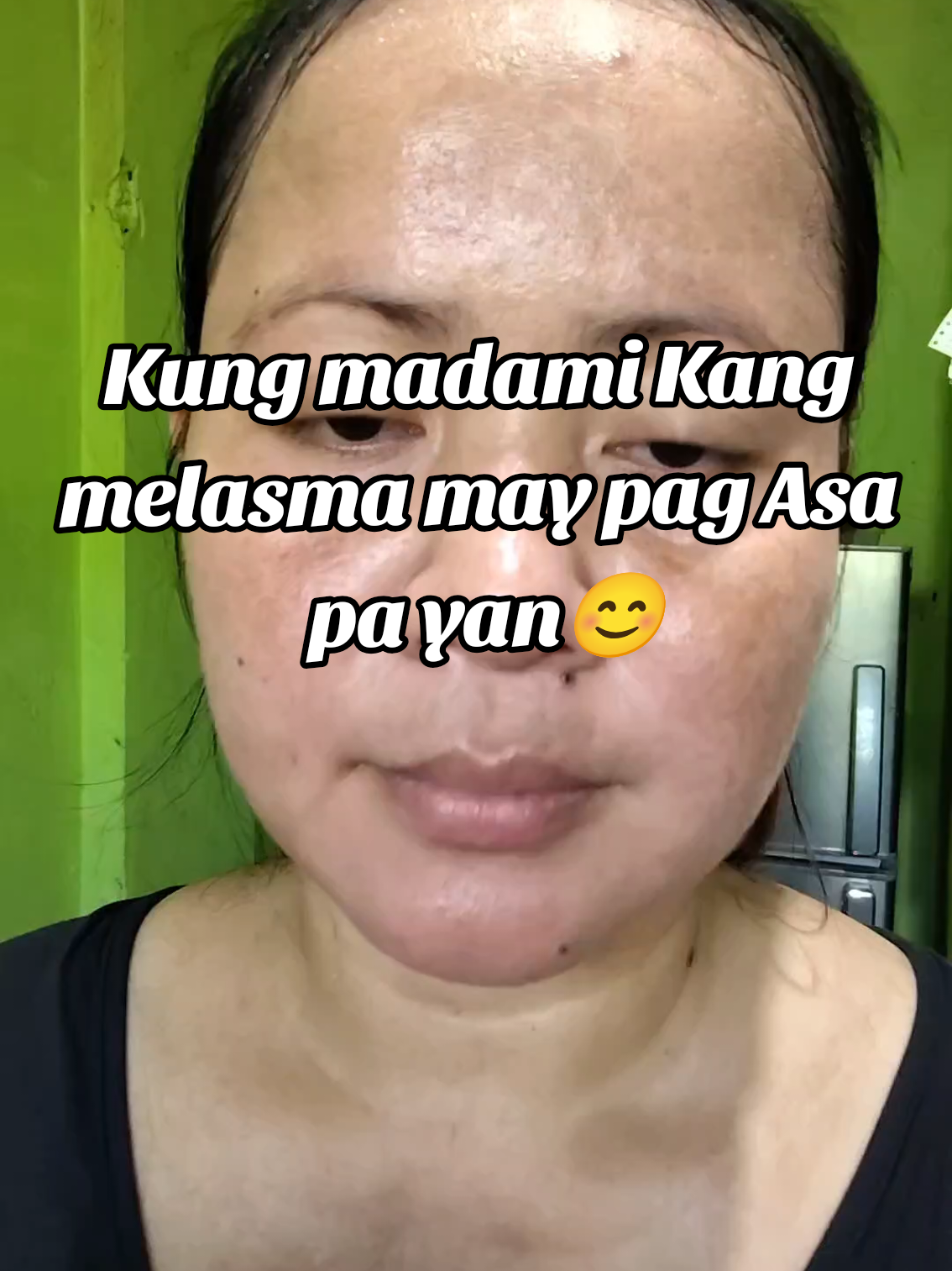 Suhada brigthening melasma lemon soap for melasma brigthening #whiteningsoap #Suhada #melasmaremover #melasma #melasmaproblem #melasmatreatment 