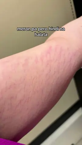 #armstretchmarks #stretchmark #darkstretchmark #stretchmarkcream #insecurities 