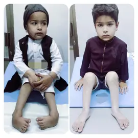 Clubfoot will be cured by treatment!!! If children born with clubfoot get timely treatment, they will walk like any other healthy child, and go to school!! #ClubfootAwareness #clubfootjourney#talipesbaby  #ponsetimethod#piedbot #everybody#millionviews  #health #capcut #inshot #today #trend#followers#vir #fypage #doctors #millionviews #who #baby #children #future #disability #awareness #goviral #children #city #travel #sunday #information #karachi#pakistan #islamabad #lahore #peshawar  #doctorsoftiktok #treatment #medicalstudent #fyp #1000k #1000k #followers # #clubfoot #Healing#piebot  #clubfootjourney👣 #globaleclubfootinitiative #Transformation #everyone 