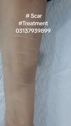 #Treatment of white(Hypopigmented) scars #Microneedling  #prp #plastic surgery  #03137939899  #DrNaveedKhan  #plastic_surgeon