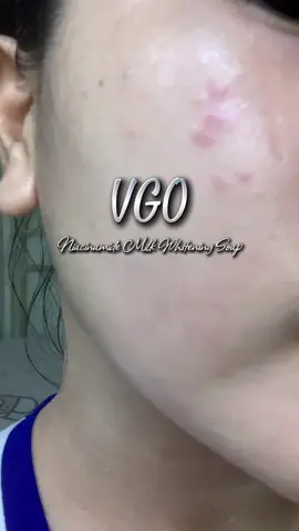 Napa lighten and less ung pimples ko nitong VGO Niacinamide Milk Whitening Soap 😍 #VGO #vgobeauty @VGO Beauty Global #fyp 