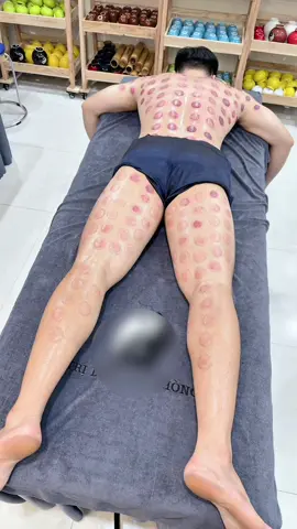 [ASMR] 全身拔罐疗法 #asmr #cuppingtherapy #massage #tbodyreset #xuhuong #like 