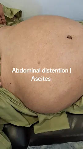 Abdominal distention I Ascites 